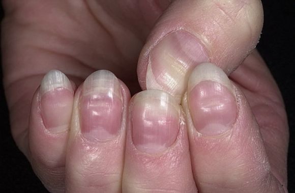Почему деформируются ногти на руках